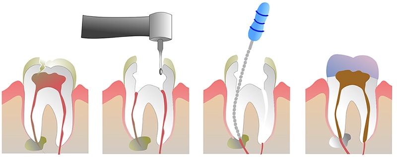 proceso de la endodoncia