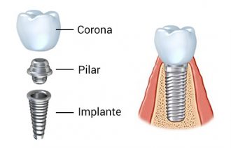 partes del implante