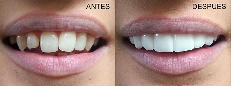 carillas dentales antes y después