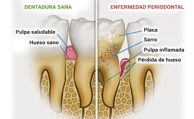 diferencias entre un diente sano y la periodontitis