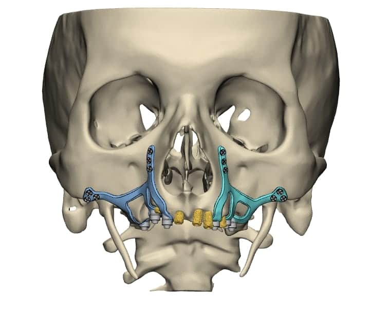  En Qu Consisten Los Implantes Subperi sticos O Yuxta seos 