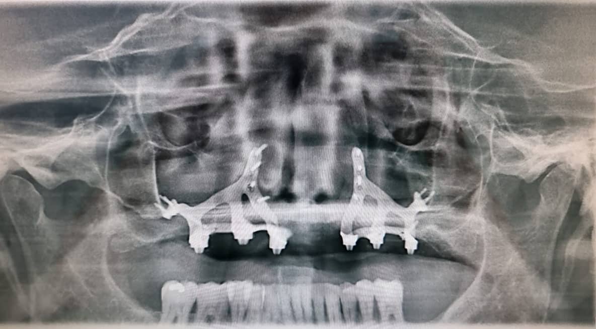 radiografía de implantes subperiosticos